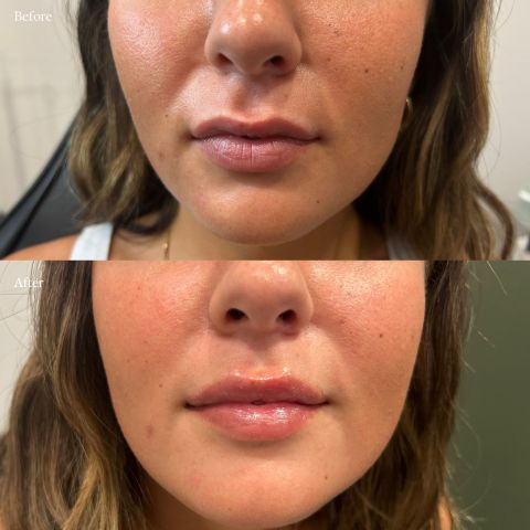 Lip Filler